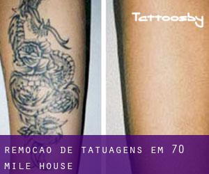 Remoção de tatuagens em 70 Mile House