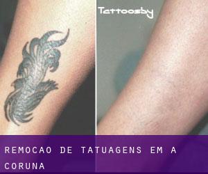 Remoção de tatuagens em A Coruña