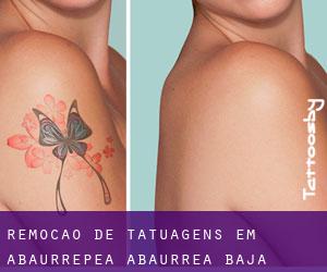 Remoção de tatuagens em Abaurrepea / Abaurrea Baja