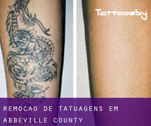 Remoção de tatuagens em Abbeville County