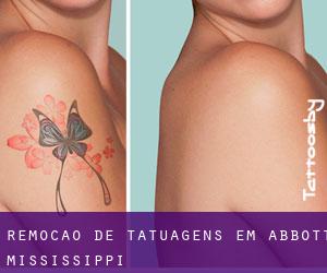 Remoção de tatuagens em Abbott (Mississippi)