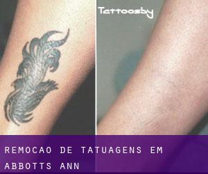 Remoção de tatuagens em Abbotts Ann