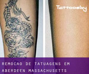 Remoção de tatuagens em Aberdeen (Massachusetts)