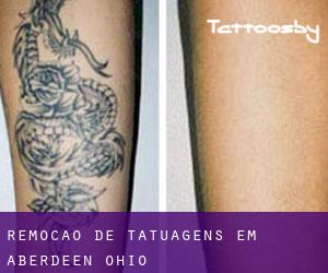 Remoção de tatuagens em Aberdeen (Ohio)