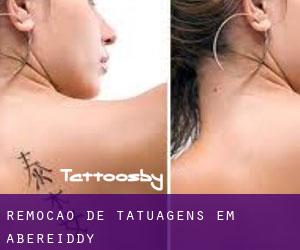 Remoção de tatuagens em Abereiddy