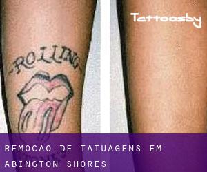 Remoção de tatuagens em Abington Shores