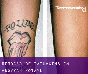 Remoção de tatuagens em Abovyan (Kotaykʼ)