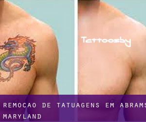 Remoção de tatuagens em Abrams (Maryland)