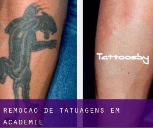 Remoção de tatuagens em Academie