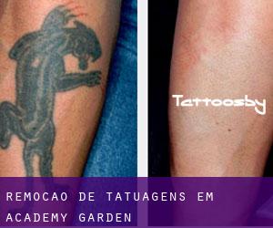 Remoção de tatuagens em Academy Garden