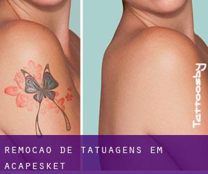 Remoção de tatuagens em Acapesket
