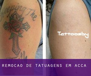Remoção de tatuagens em Acca