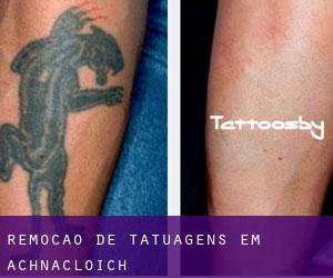 Remoção de tatuagens em Achnacloich