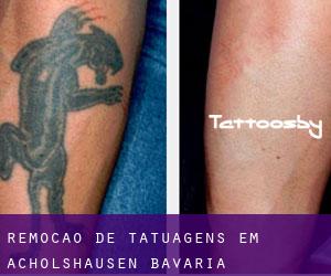 Remoção de tatuagens em Acholshausen (Bavaria)