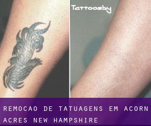 Remoção de tatuagens em Acorn Acres (New Hampshire)