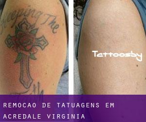 Remoção de tatuagens em Acredale (Virginia)
