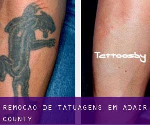 Remoção de tatuagens em Adair County
