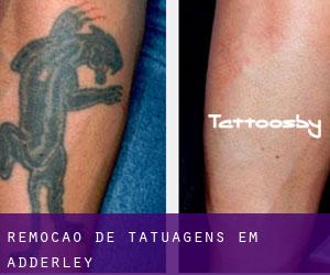Remoção de tatuagens em Adderley