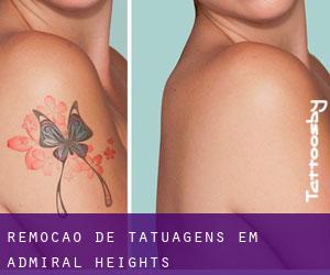 Remoção de tatuagens em Admiral Heights