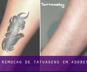 Remoção de tatuagens em Adobes