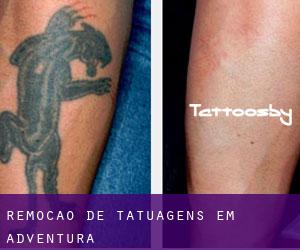 Remoção de tatuagens em Adventura