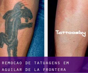 Remoção de tatuagens em Aguilar de la Frontera