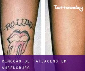 Remoção de tatuagens em Ahrensburg