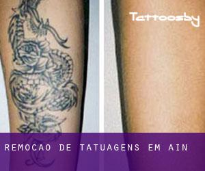 Remoção de tatuagens em Aín
