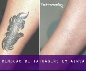 Remoção de tatuagens em Aínsa