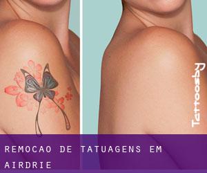 Remoção de tatuagens em Airdrie