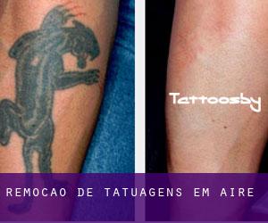 Remoção de tatuagens em Aire