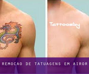 Remoção de tatuagens em Airor