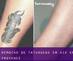 Remoção de tatuagens em Aix-en-Provence