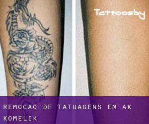 Remoção de tatuagens em Ak Komelik