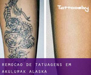 Remoção de tatuagens em Akulurak (Alaska)