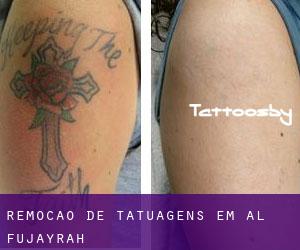 Remoção de tatuagens em Al Fujayrah