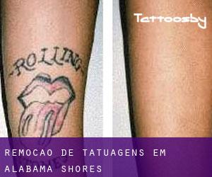 Remoção de tatuagens em Alabama Shores