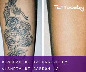 Remoção de tatuagens em Alameda de Gardón (La)