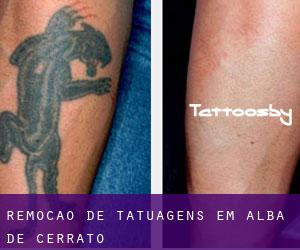 Remoção de tatuagens em Alba de Cerrato
