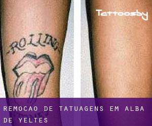 Remoção de tatuagens em Alba de Yeltes