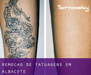 Remoção de tatuagens em Albacete