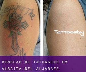 Remoção de tatuagens em Albaida del Aljarafe