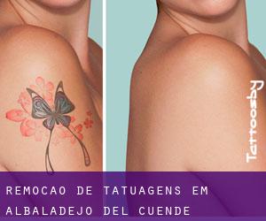 Remoção de tatuagens em Albaladejo del Cuende