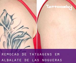 Remoção de tatuagens em Albalate de las Nogueras