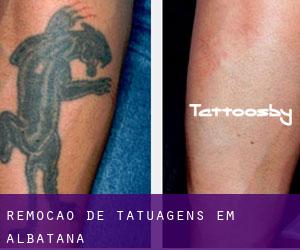 Remoção de tatuagens em Albatana