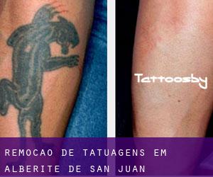 Remoção de tatuagens em Alberite de San Juan