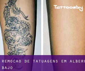 Remoção de tatuagens em Albero Bajo