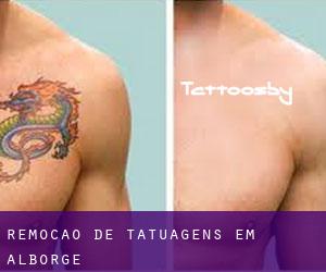 Remoção de tatuagens em Alborge