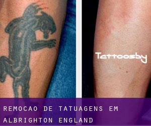 Remoção de tatuagens em Albrighton (England)