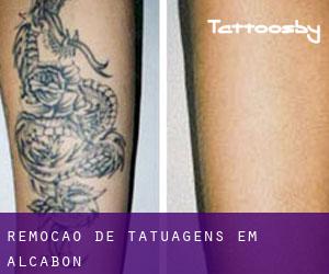 Remoção de tatuagens em Alcabón